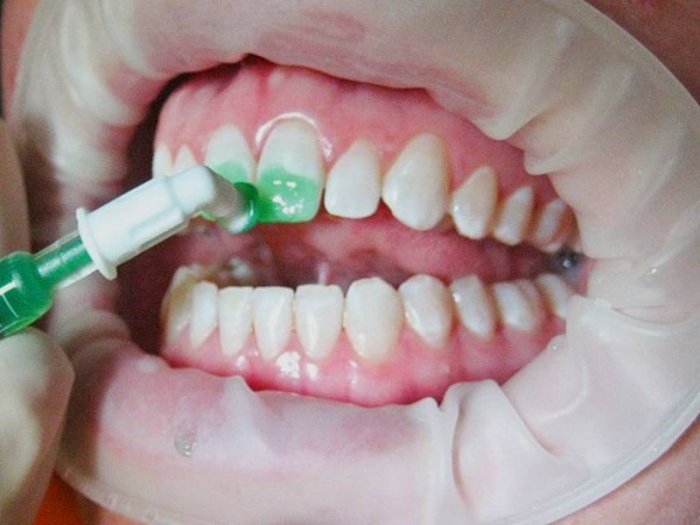Лечение зубов без сверления
