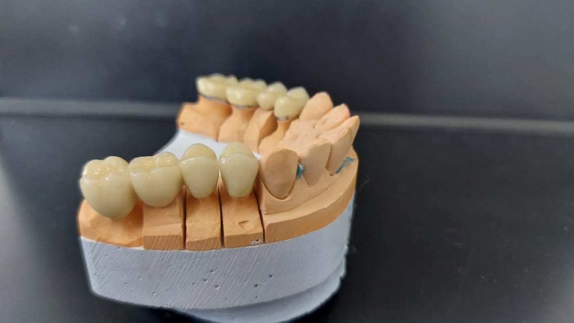 протезирование зубов тамбов цены